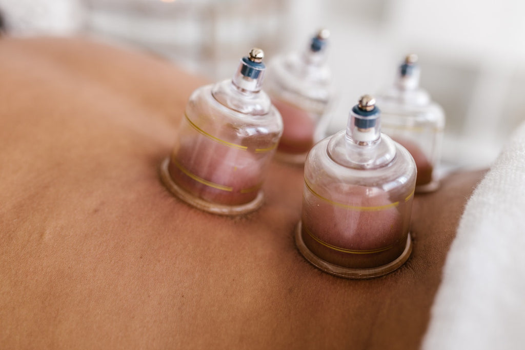 Cupping Therapy, Definition and Benefits